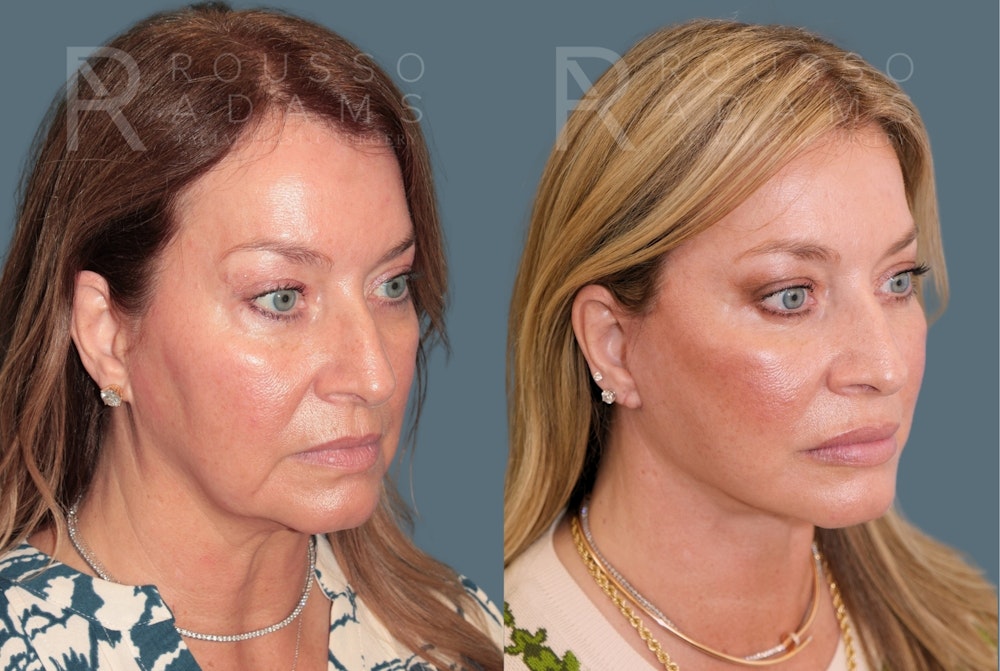 Deep Plane Facelift <span class=small>By Dr. Daniel Rousso</span> Before & After Gallery - Patient 301385 - Image 1