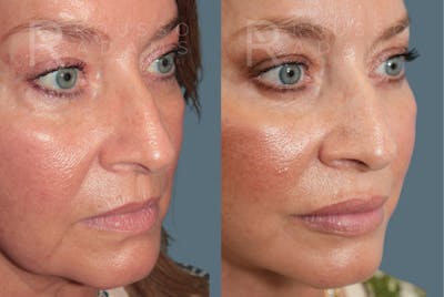 Deep Plane Facelift <span class=small>By Dr. Daniel Rousso</span> Before & After Gallery - Patient 301385 - Image 4