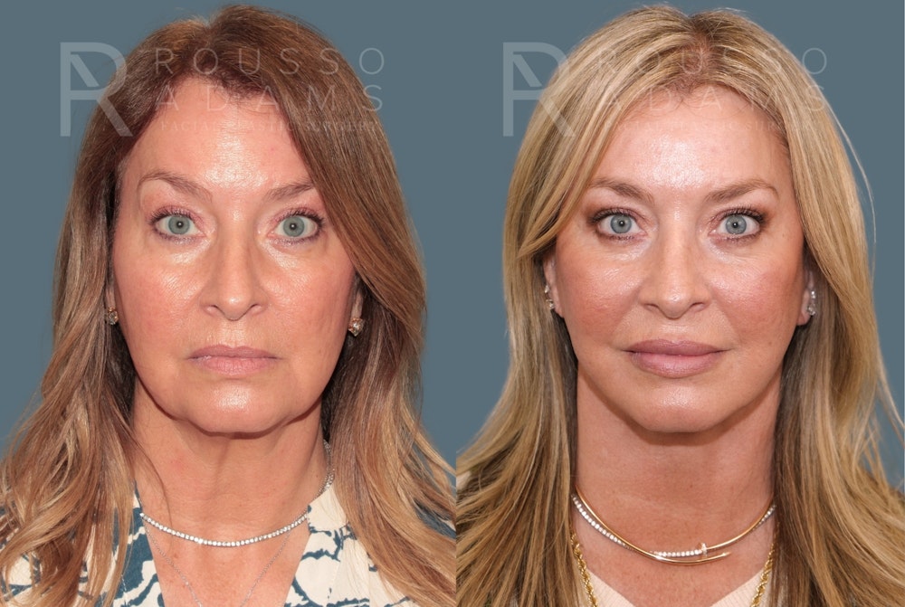 Deep Plane Facelift <span class=small>By Dr. Daniel Rousso</span> Before & After Gallery - Patient 301385 - Image 3
