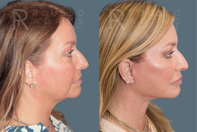 Deep Plane Facelift <span class=small>By Dr. Daniel Rousso</span> Before & After Gallery - Patient 301385 - Image 2