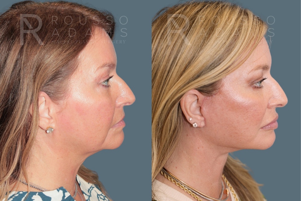 Deep Plane Facelift <span class=small>By Dr. Daniel Rousso</span> Before & After Gallery - Patient 301385 - Image 2