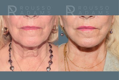 Deep Plane Facelift <span class=small>By Dr. Daniel Rousso</span> Before & After Gallery - Patient 596579 - Image 4