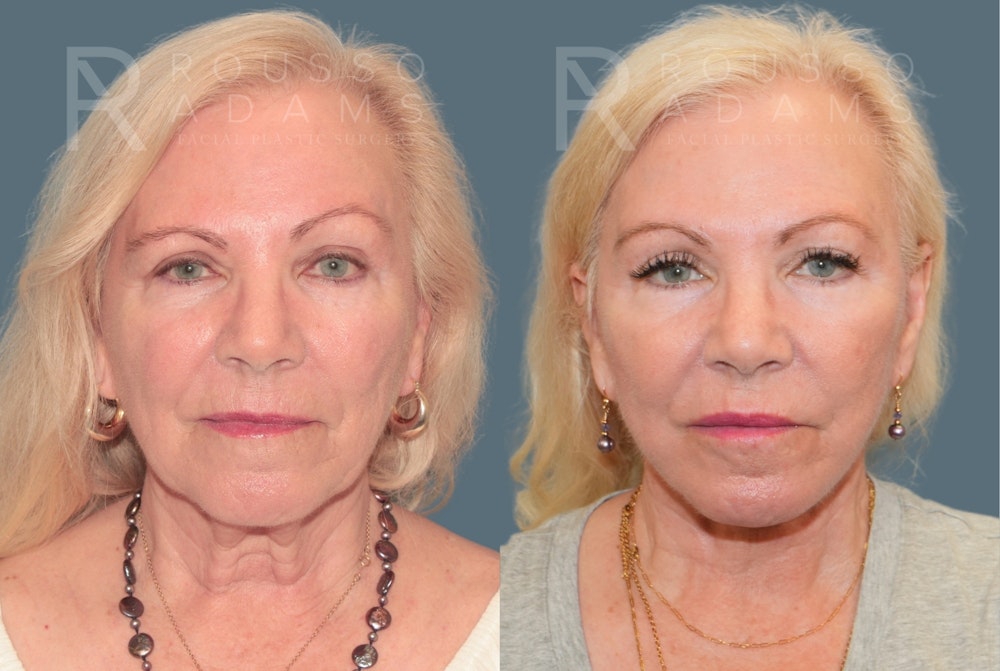 Deep Plane Facelift <span class=small>By Dr. Daniel Rousso</span> Before & After Gallery - Patient 596579 - Image 3