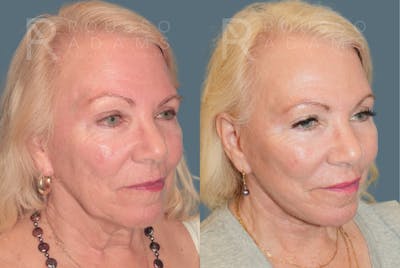 Deep Plane Facelift <span class=small>By Dr. Daniel Rousso</span> Before & After Gallery - Patient 596579 - Image 1