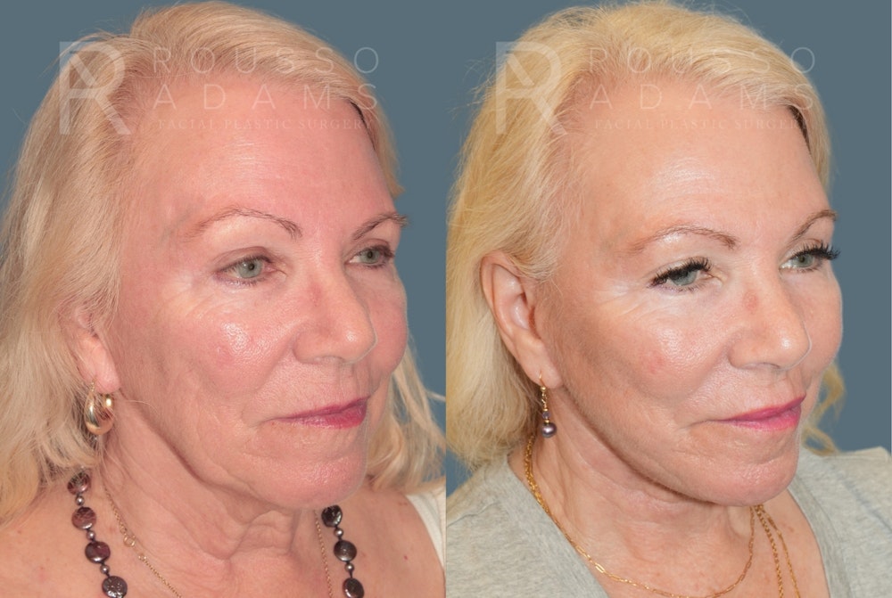 Deep Plane Facelift <span class=small>By Dr. Daniel Rousso</span> Before & After Gallery - Patient 596579 - Image 1