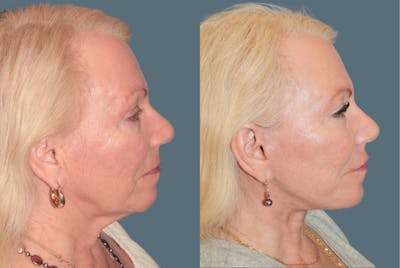 Deep Plane Facelift <span class=small>By Dr. Daniel Rousso</span> Before & After Gallery - Patient 596579 - Image 2