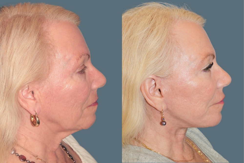 Deep Plane Facelift <span class=small>By Dr. Daniel Rousso</span> Before & After Gallery - Patient 596579 - Image 2
