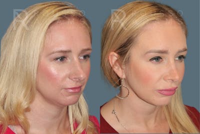 Rhinoplasty <span class=small>By Dr. Daniel Rousso</span> Before & After Gallery - Patient 464559 - Image 2