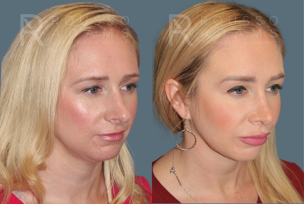 Rhinoplasty <span class=small>By Dr. Daniel Rousso</span> Before & After Gallery - Patient 464559 - Image 2