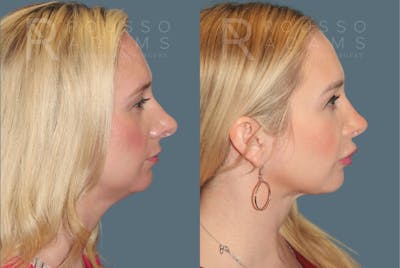 Rhinoplasty <span class=small>By Dr. Daniel Rousso</span> Before & After Gallery - Patient 464559 - Image 1