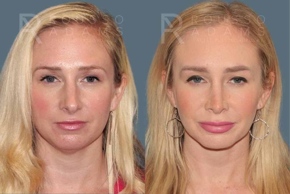 Rhinoplasty <span class=small>By Dr. Daniel Rousso</span> Before & After Gallery - Patient 464559 - Image 3