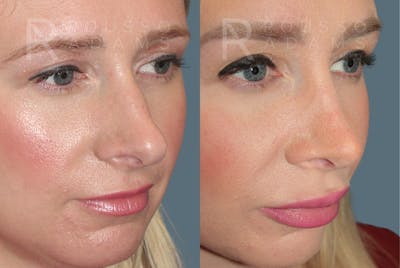 Rhinoplasty <span class=small>By Dr. Daniel Rousso</span> Before & After Gallery - Patient 464559 - Image 4