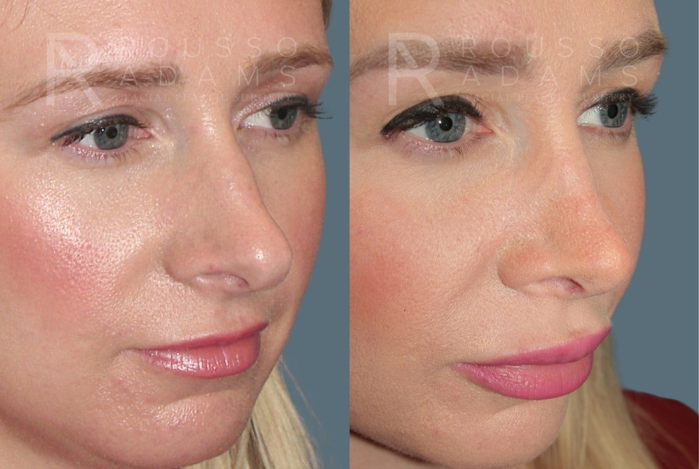 Rhinoplasty <span class=small>By Dr. Daniel Rousso</span> Before & After Gallery - Patient 464559 - Image 4