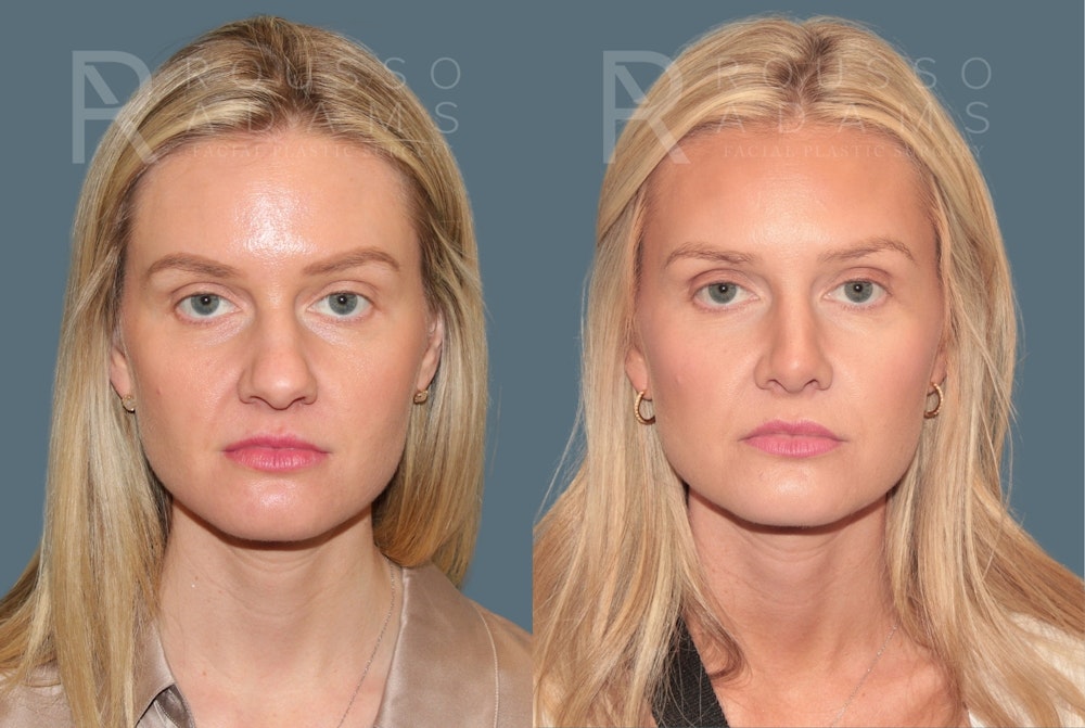 Rhinoplasty <span class=small>By Dr. Daniel Rousso</span> Before & After Gallery - Patient 165493 - Image 3