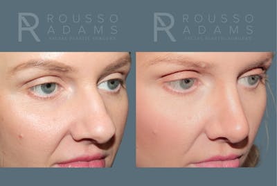 Rhinoplasty <span class=small>By Dr. Daniel Rousso</span> Before & After Gallery - Patient 165493 - Image 4