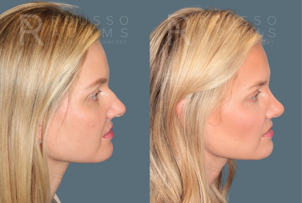Rhinoplasty <span class=small>By Dr. Daniel Rousso</span> Before & After Gallery - Patient 165493 - Image 1