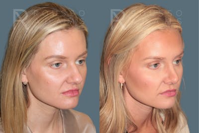 Rhinoplasty <span class=small>By Dr. Daniel Rousso</span> Before & After Gallery - Patient 165493 - Image 2