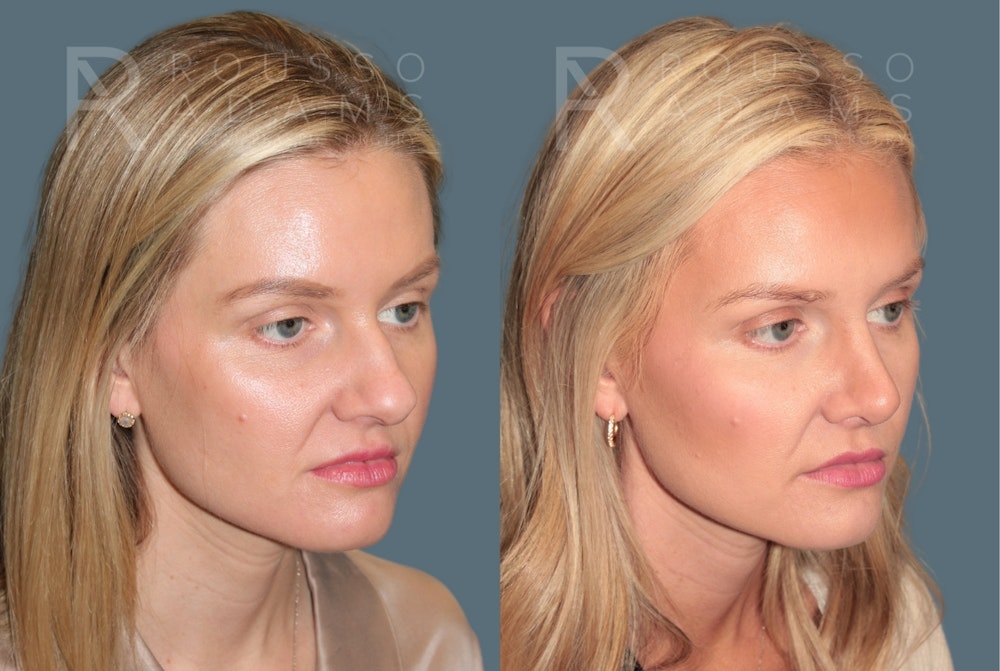 Rhinoplasty <span class=small>By Dr. Daniel Rousso</span> Before & After Gallery - Patient 165493 - Image 2