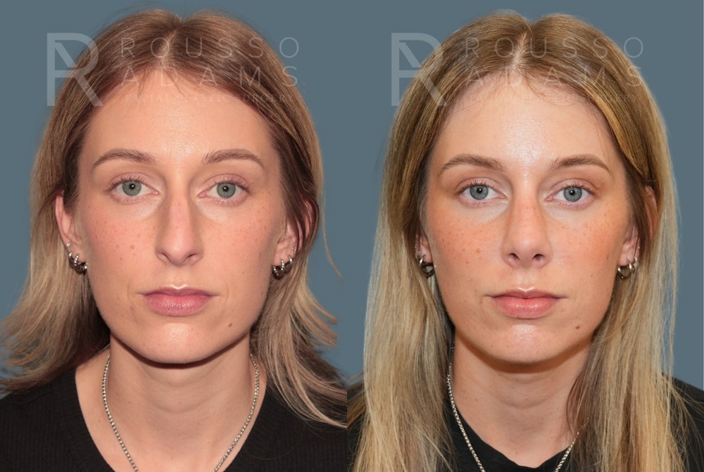 Rhinoplasty <span class=small>By Dr. Daniel Rousso</span> Before & After Gallery - Patient 158270 - Image 3