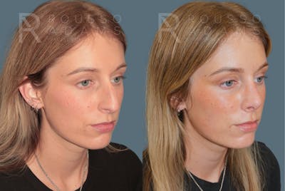 Rhinoplasty <span class=small>By Dr. Daniel Rousso</span> Before & After Gallery - Patient 158270 - Image 2