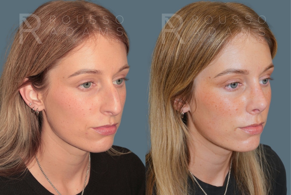Rhinoplasty <span class=small>By Dr. Daniel Rousso</span> Before & After Gallery - Patient 158270 - Image 2