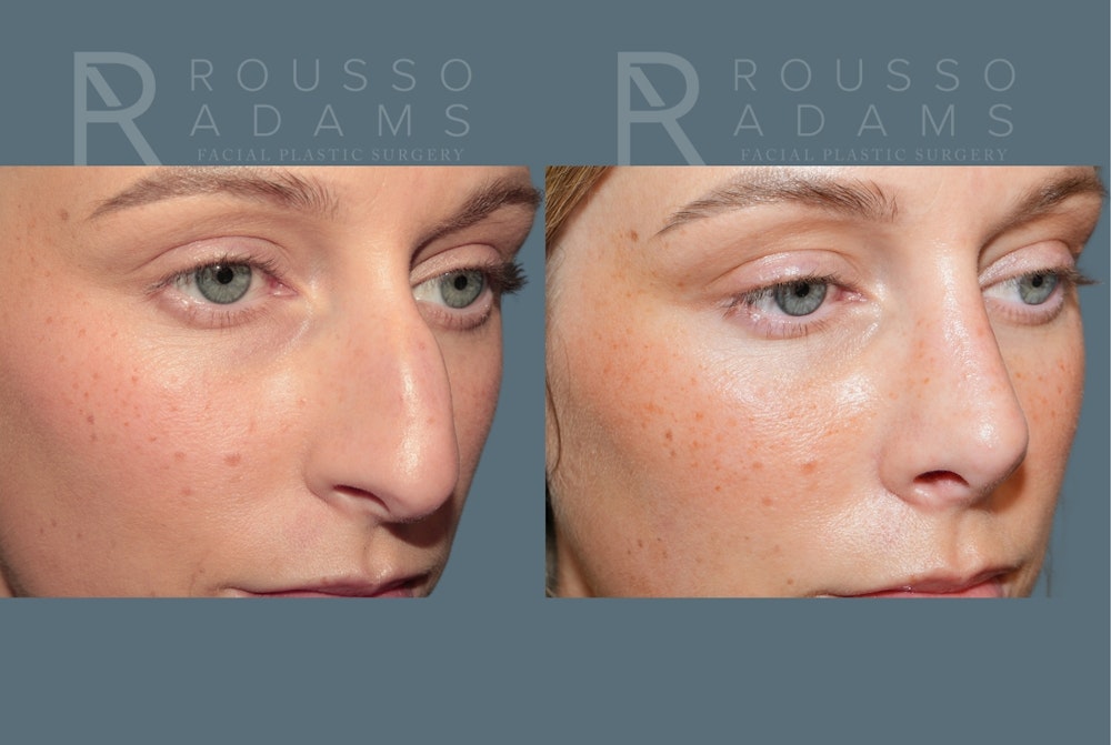 Rhinoplasty <span class=small>By Dr. Daniel Rousso</span> Before & After Gallery - Patient 158270 - Image 5