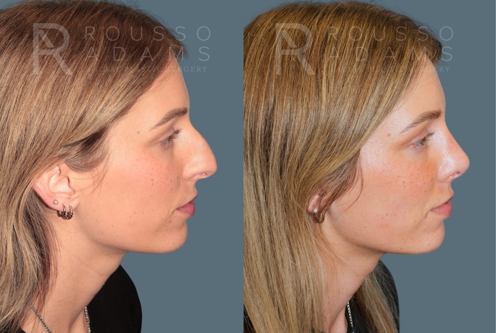 Rhinoplasty <span class=small>By Dr. Daniel Rousso</span> Before & After Gallery - Patient 158270 - Image 1