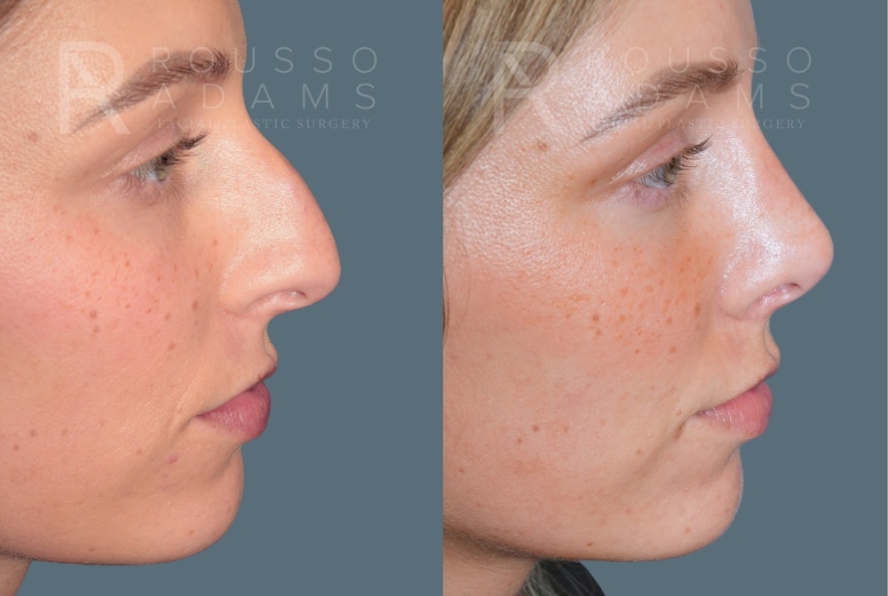 Rhinoplasty <span class=small>By Dr. Daniel Rousso</span> Before & After Gallery - Patient 158270 - Image 4