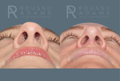 Rhinoplasty <span class=small>By Dr. Daniel Rousso</span> Before & After Gallery - Patient 158270 - Image 6