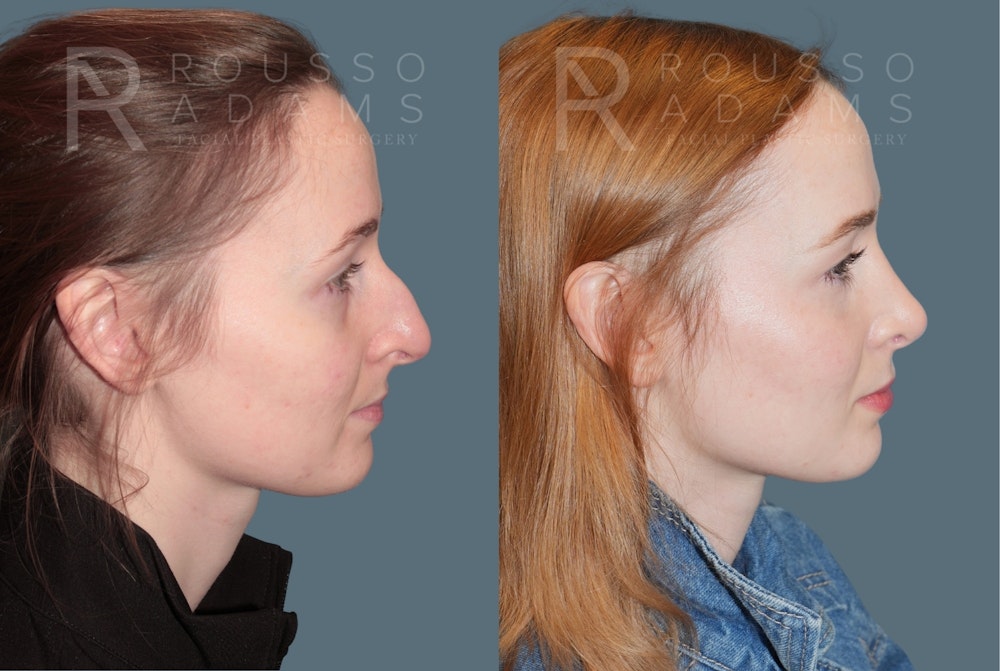 Rhinoplasty <span class=small>By Dr. Daniel Rousso</span> Before & After Gallery - Patient 179521 - Image 1