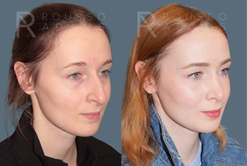 Rhinoplasty <span class=small>By Dr. Daniel Rousso</span> Before & After Gallery - Patient 179521 - Image 2