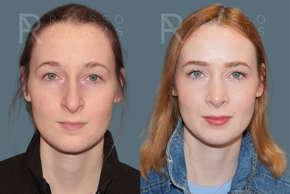Rhinoplasty <span class=small>By Dr. Daniel Rousso</span> Before & After Gallery - Patient 179521 - Image 3