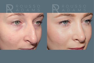 Rhinoplasty <span class=small>By Dr. Daniel Rousso</span> Before & After Gallery - Patient 179521 - Image 4