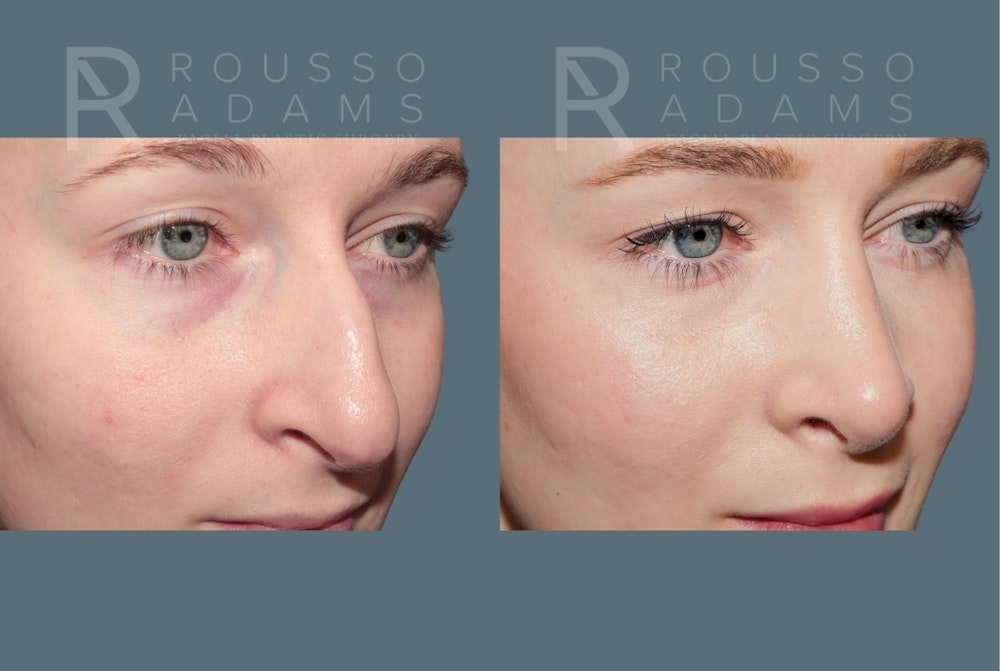 Rhinoplasty <span class=small>By Dr. Daniel Rousso</span> Before & After Gallery - Patient 179521 - Image 4