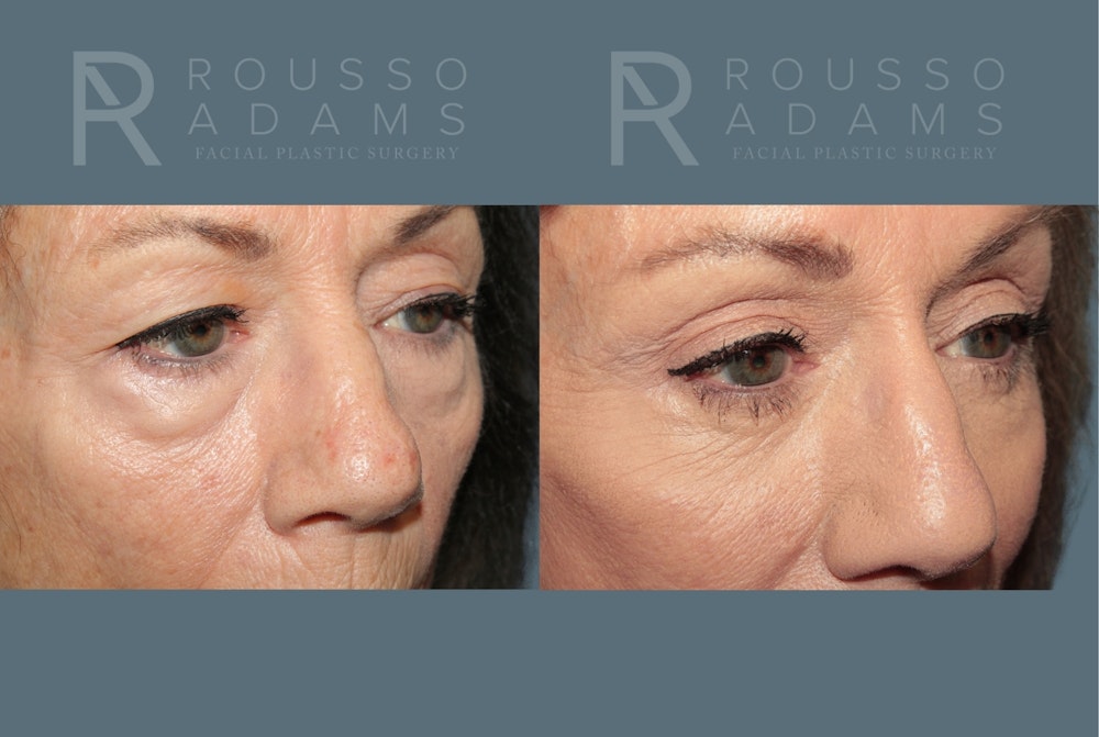 Deep Plane Facelift <span class=small>By Dr. Austin Adams</span> Before & After Gallery - Patient 161031 - Image 4