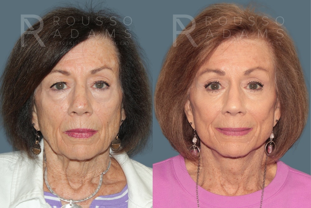 Deep Plane Facelift <span class=small>By Dr. Austin Adams</span> Before & After Gallery - Patient 161031 - Image 3