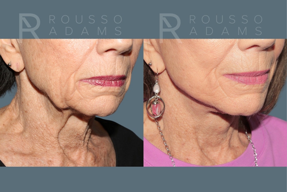 Deep Plane Facelift <span class=small>By Dr. Austin Adams</span> Before & After Gallery - Patient 161031 - Image 5