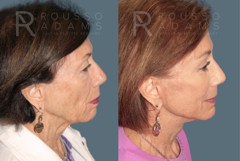 Deep Plane Facelift <span class=small>By Dr. Austin Adams</span> Before & After Gallery - Patient 161031 - Image 2
