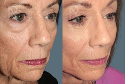 Deep Plane Facelift <span class=small>By Dr. Austin Adams</span> Before & After Gallery - Patient 161031 - Image 6