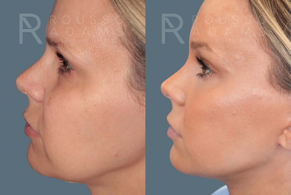 Deep Plane Facelift <span class=small>By Dr. Austin Adams</span> Before & After Gallery - Patient 344642 - Image 3