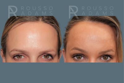 Deep Plane Facelift <span class=small>By Dr. Austin Adams</span> Before & After Gallery - Patient 344642 - Image 6