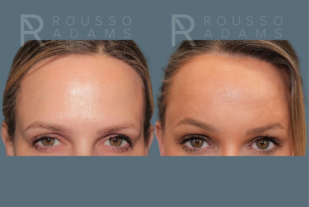 Deep Plane Facelift <span class=small>By Dr. Austin Adams</span> Before & After Gallery - Patient 344642 - Image 6