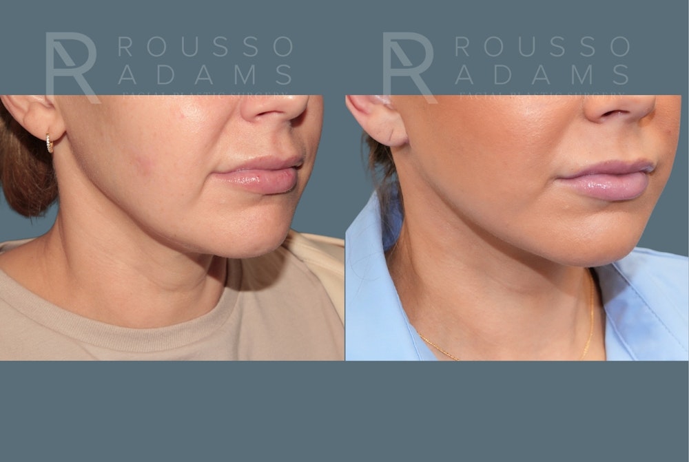 Deep Plane Facelift <span class=small>By Dr. Austin Adams</span> Before & After Gallery - Patient 344642 - Image 5