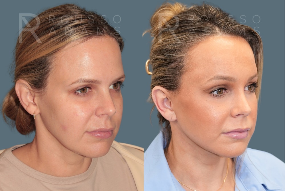 Deep Plane Facelift <span class=small>By Dr. Austin Adams</span> Before & After Gallery - Patient 344642 - Image 1