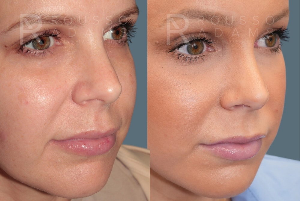Deep Plane Facelift <span class=small>By Dr. Austin Adams</span> Before & After Gallery - Patient 344642 - Image 4