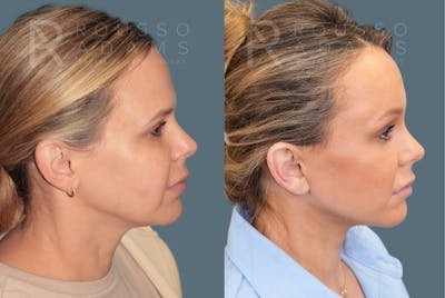 Deep Plane Facelift <span class=small>By Dr. Austin Adams</span> Before & After Gallery - Patient 344642 - Image 2