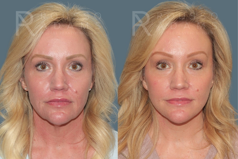 Deep Plane Facelift <span class=small>By Dr. Austin Adams</span> Before & After Gallery - Patient 274983 - Image 3