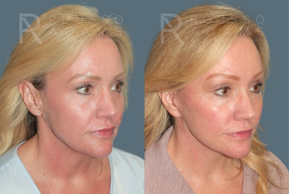 Deep Plane Facelift <span class=small>By Dr. Austin Adams</span> Before & After Gallery - Patient 274983 - Image 1