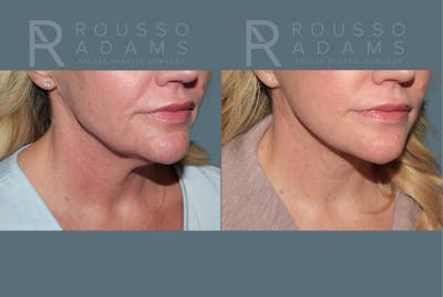 Deep Plane Facelift <span class=small>By Dr. Austin Adams</span> Before & After Gallery - Patient 274983 - Image 4