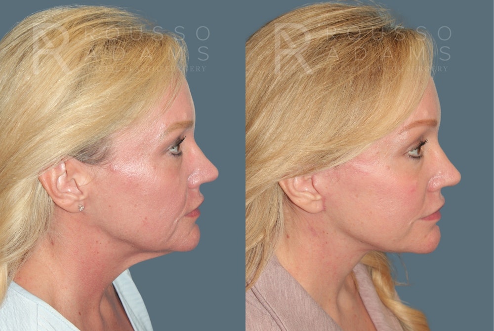 Deep Plane Facelift <span class=small>By Dr. Austin Adams</span> Before & After Gallery - Patient 274983 - Image 2